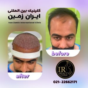 زیبایی ایران زمین کاشت مو تخصصی آقایان کاشت ابرو بانوان در الهیه 10