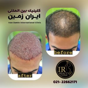 زیبایی ایران زمین کاشت مو تخصصی آقایان کاشت ابرو بانوان در الهیه 3