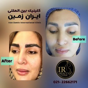 زیبایی ایران زمین کاشت مو تخصصی آقایان کاشت ابرو بانوان در الهیه 4