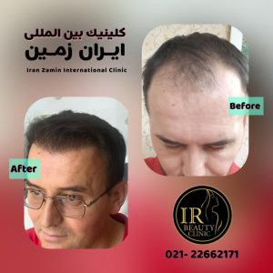 زیبایی ایران زمین کاشت مو تخصصی آقایان کاشت ابرو بانوان در الهیه 8