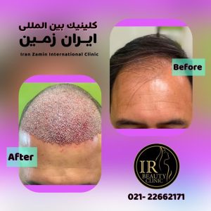 زیبایی ایران زمین کاشت مو تخصصی آقایان کاشت ابرو بانوان در الهیه 9