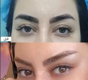 ‏زیبایی ‏نیک ‏خدمات ‏لیزر ‏موهای ‏زائد ‏و ‏بلفاروپلاستی ‏و کاشت ‏تخصصی ‏ابرو ‏در ‏کرج ‏گلشهر 11