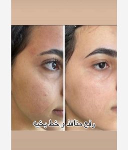 قدیانی فر خدمات تزریق بوتاکس مزوژل مزوتراپی در تهران زعفرانیه 20
