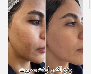 قدیانی فر خدمات تزریق بوتاکس مزوژل مزوتراپی در تهران زعفرانیه 21