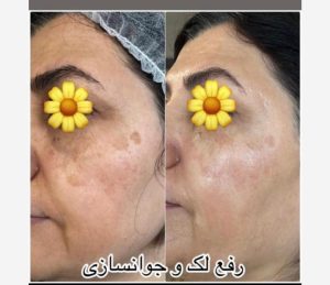 قدیانی فر خدمات تزریق بوتاکس مزوژل مزوتراپی در تهران زعفرانیه 22
