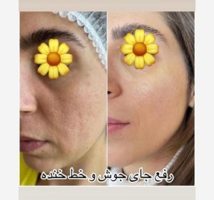قدیانی فر خدمات تزریق بوتاکس مزوژل مزوتراپی در تهران زعفرانیه 23