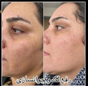 قدیانی فر خدمات تزریق بوتاکس مزوژل مزوتراپی در تهران زعفرانیه 26
