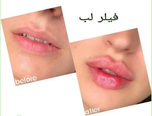 ‏فهیمه ‏درفشی ‏خدمات ‏مزوژل ‏کاشت ‏مو ‏بوتاکس ‏در ‏تهران شریعتی 8 1