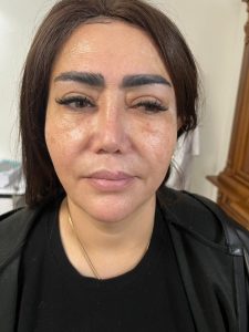 ‏دکتر ‏کاشانی ‏لیزر ‏مزوتراپی ‏اندولیفت ‏در ‏تهران پاسداران 3