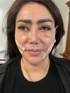 ‏دکتر ‏کاشانی ‏لیزر ‏مزوتراپی ‏اندولیفت ‏در ‏تهران پاسداران 4